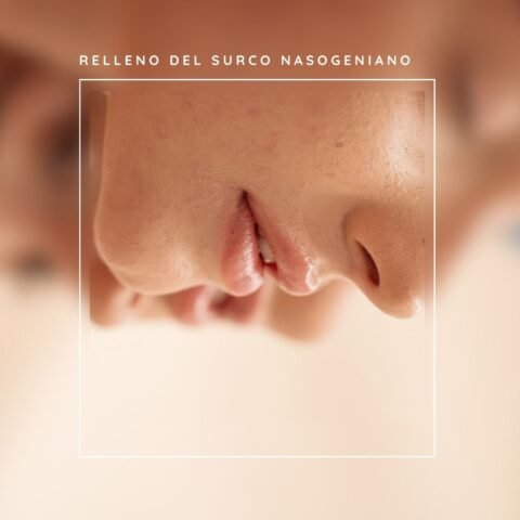 Antes y después del relleno de surco nasogeniano