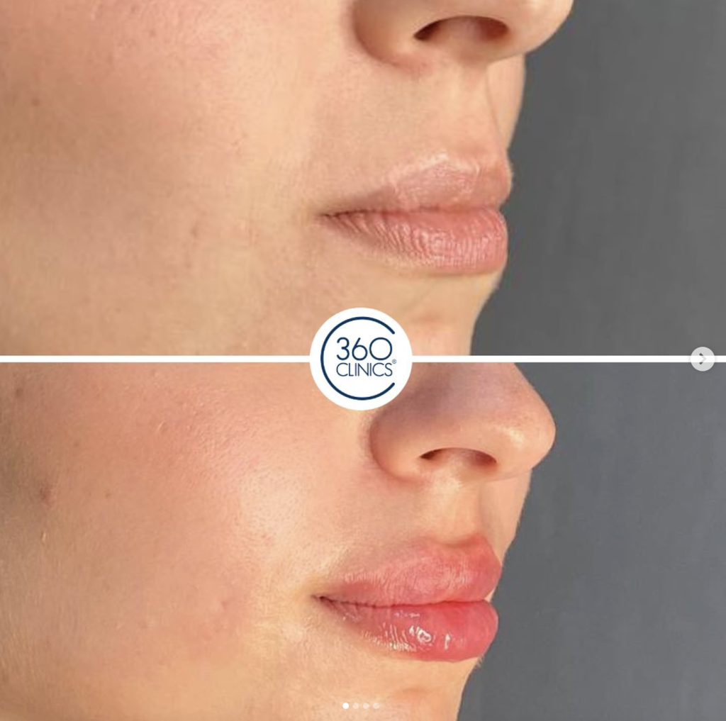 antes y despuÃ©s hidrataciÃ³n de labios con Ã¡cido hialurÃ³nico