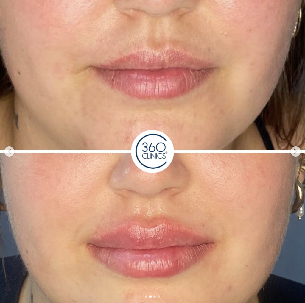 antes y despuÃ©s aumento de labios con Ã¡cido hialurÃ³nico