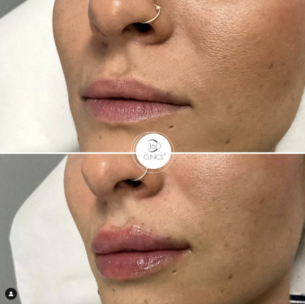 antes y despues aumento de labios con acido hialurónico