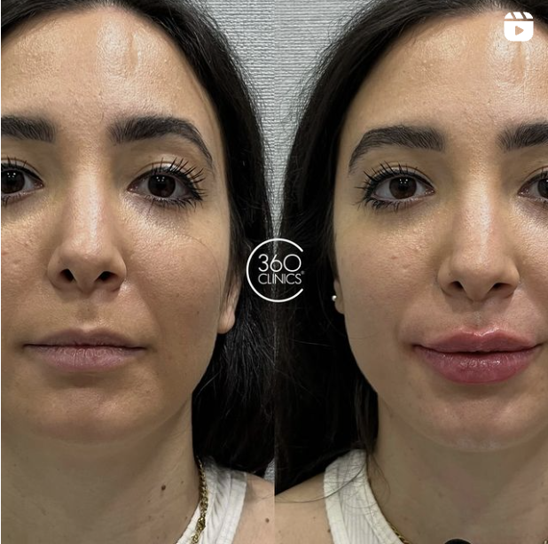antes y después aumento de labios con ácido hialurónico