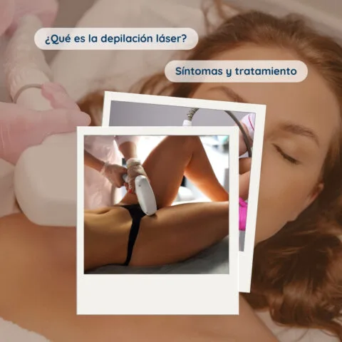 Depilación láser, qué es, síntomas y tratamiento