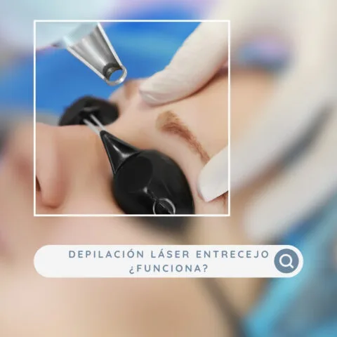 Depilarse con láser el entrecejo, ¿funciona o es un mito?