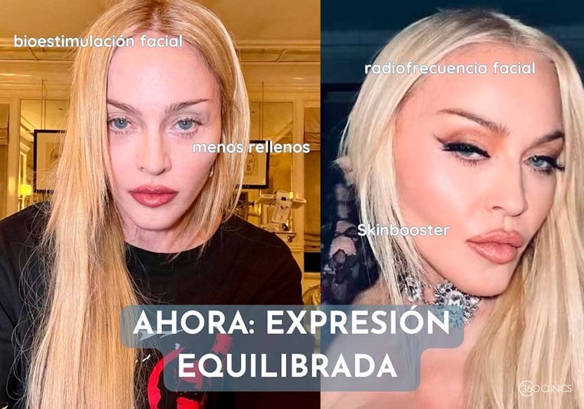 Gracias a tratamientos como skinbooster, polinucleotidos o inductores de colageno, la cara de Madonna esta desinflamada y equilibrada