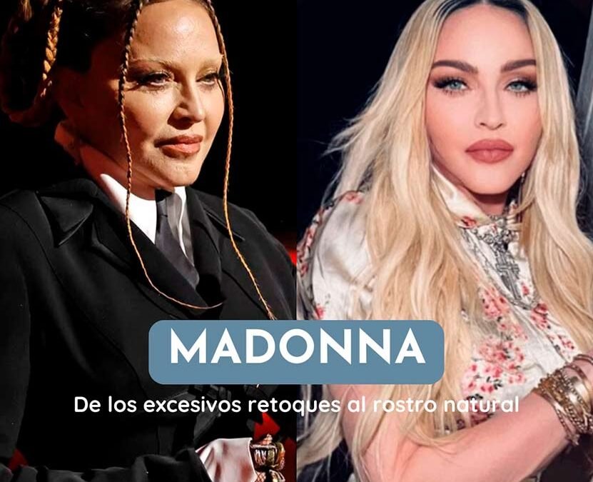 El Antes y Después de Madonna: del Rostro Excesivo al Equilibrio