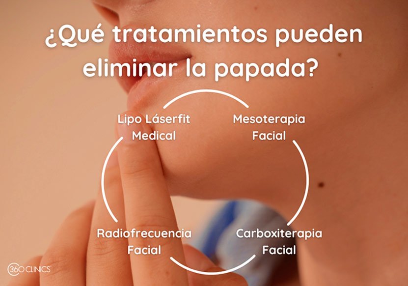 el lipolaser, la mesoterapia, la carboxiterapia, y la radiofrecuencia facial son los mejores tratamientos para eliminar papada