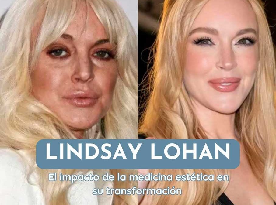 El Antes y Después de Lindsay Lohan: el Impacto de la Medicina Estética